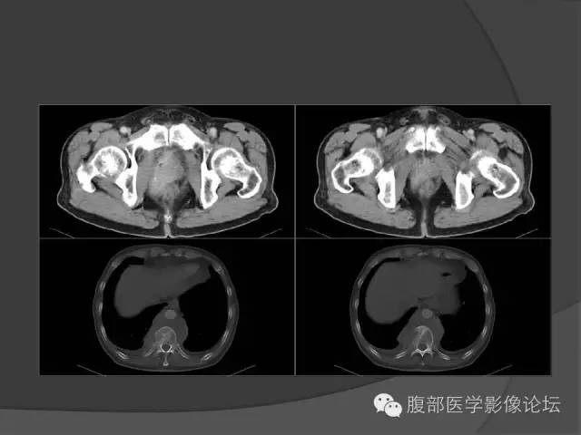 【病例】前列腺恶性淋巴瘤1例CT影像表现