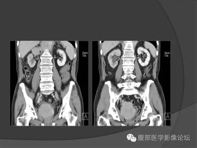 【病例】前列腺恶性淋巴瘤1例CT影像表现