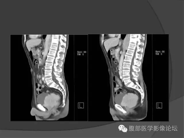 【病例】前列腺恶性淋巴瘤1例CT影像表现