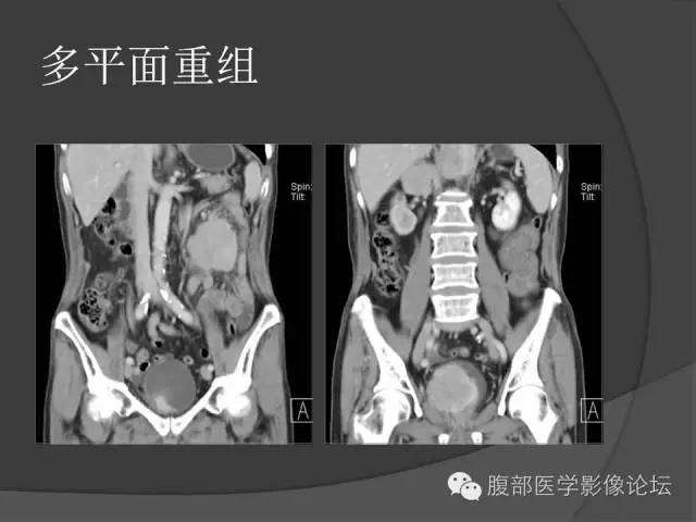 【病例】前列腺恶性淋巴瘤1例CT影像表现
