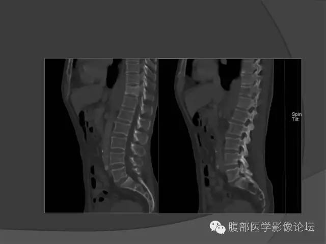 【病例】前列腺恶性淋巴瘤1例CT影像表现
