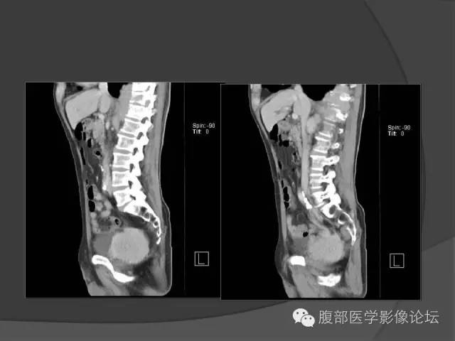 【病例】前列腺恶性淋巴瘤1例CT影像表现