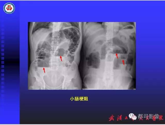 【PPT】放射科危急值影像病例点评