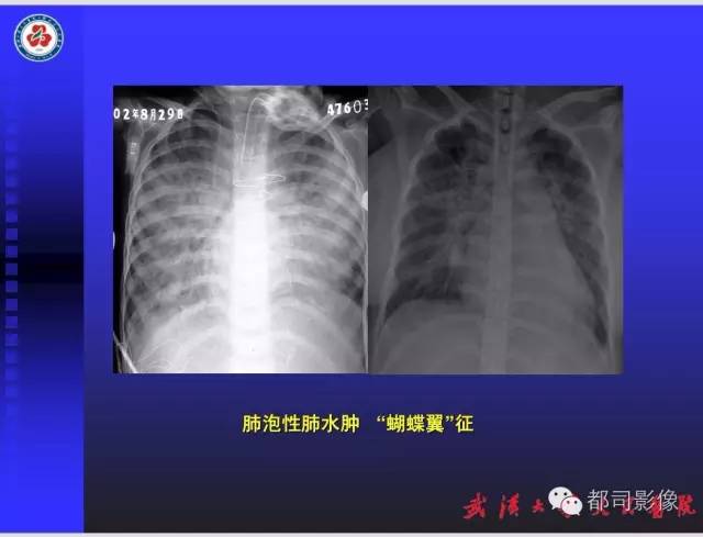 【PPT】放射科危急值影像病例点评