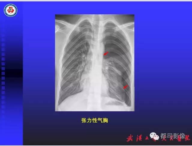 【PPT】放射科危急值影像病例点评