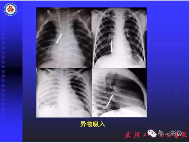 【PPT】放射科危急值影像病例点评