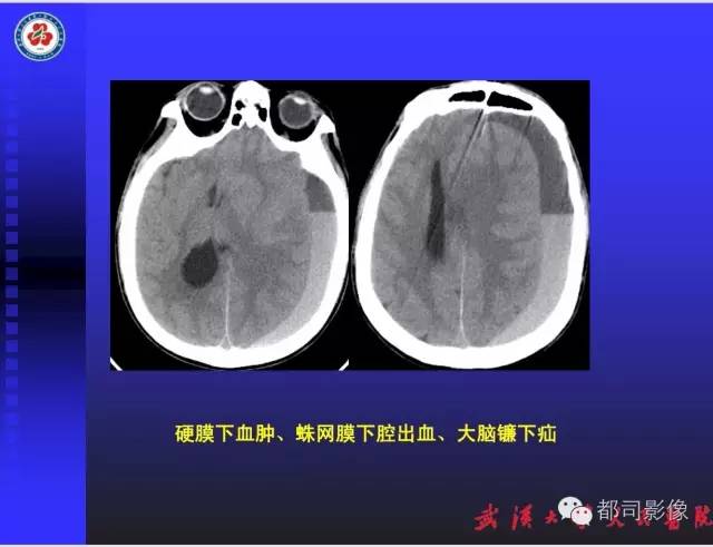 【PPT】放射科危急值影像病例点评