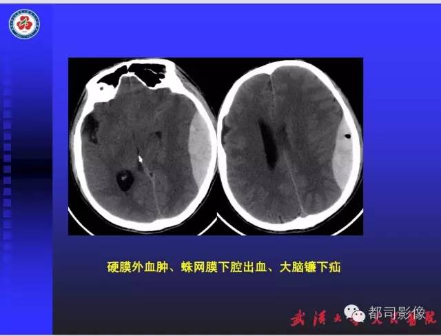 【PPT】放射科危急值影像病例点评