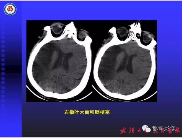 【PPT】放射科危急值影像病例点评