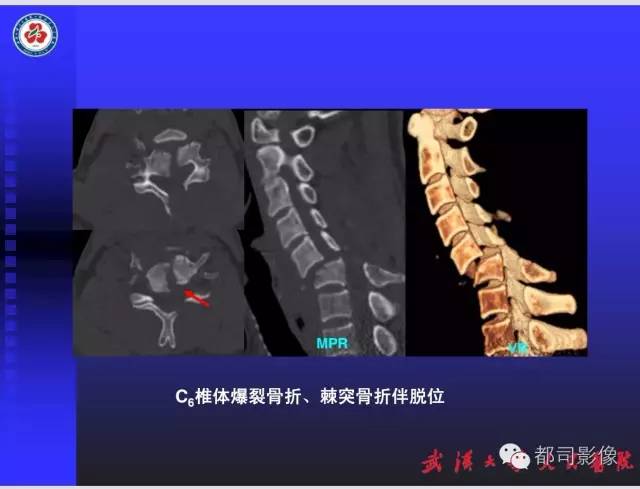【PPT】放射科危急值影像病例点评