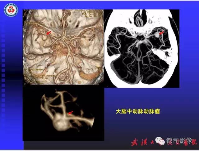 【PPT】放射科危急值影像病例点评
