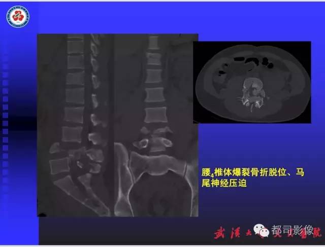 【PPT】放射科危急值影像病例点评