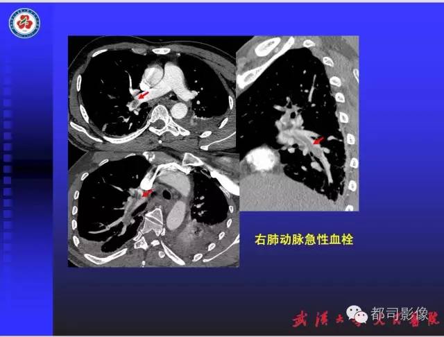 【PPT】放射科危急值影像病例点评