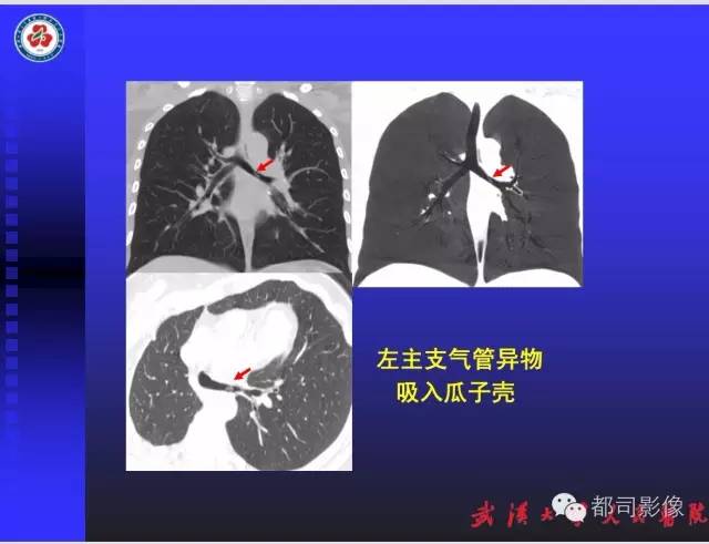 【PPT】放射科危急值影像病例点评