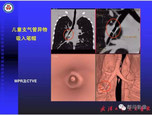 【PPT】放射科危急值影像病例点评