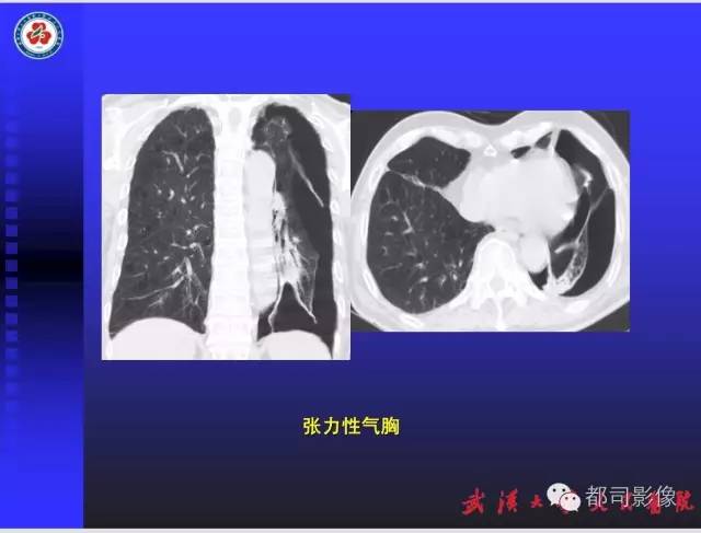 【PPT】放射科危急值影像病例点评