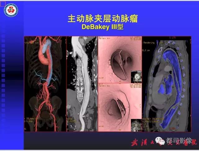 【PPT】放射科危急值影像病例点评