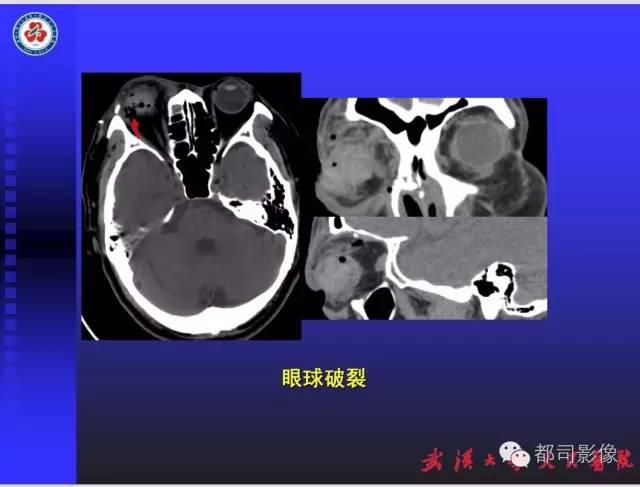 【PPT】放射科危急值影像病例点评