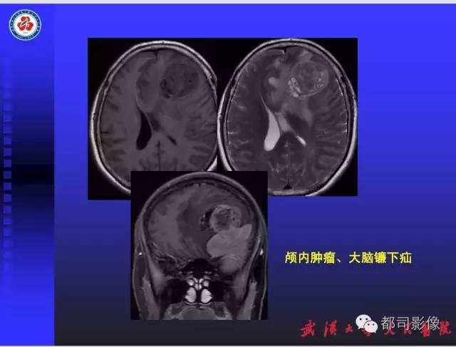 【PPT】放射科危急值影像病例点评
