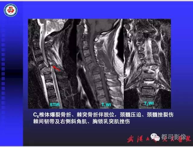 【PPT】放射科危急值影像病例点评