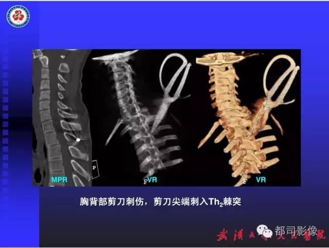【PPT】放射科危急值影像病例点评
