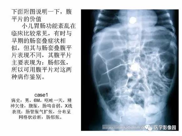 【PPT】小儿肠套叠的影像诊断与治疗