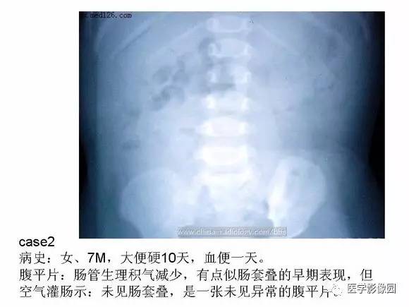 【PPT】小儿肠套叠的影像诊断与治疗