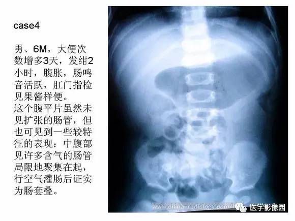 【PPT】小儿肠套叠的影像诊断与治疗