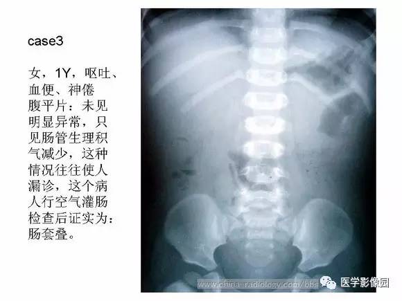 【PPT】小儿肠套叠的影像诊断与治疗