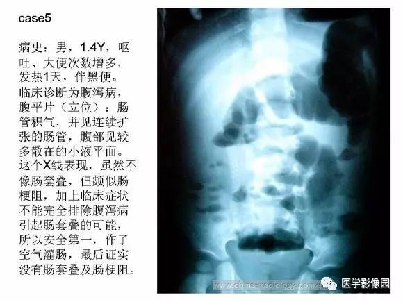 【PPT】小儿肠套叠的影像诊断与治疗