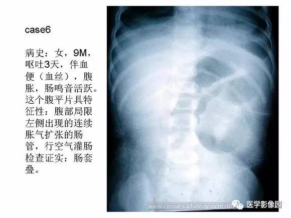 【PPT】小儿肠套叠的影像诊断与治疗