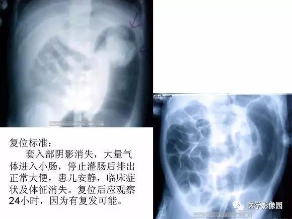 【PPT】小儿肠套叠的影像诊断与治疗