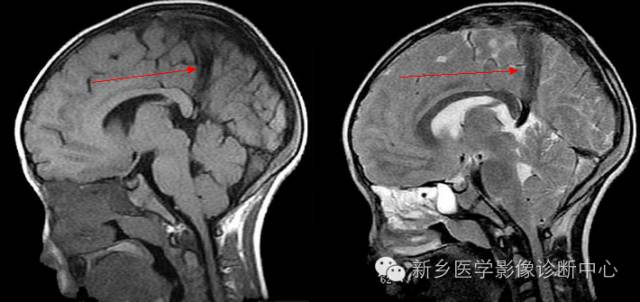永存镰状窦