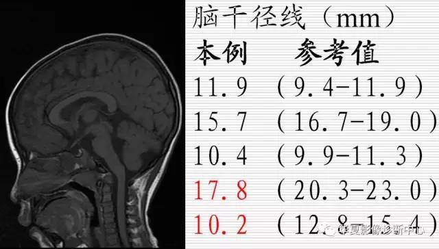 【病例】先天性肌营养不良症1例MRI表现 【病例】先天性肌营养不良症1例MRI表现