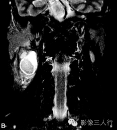 【病例】鳃裂囊肿并感染1例MR影像表现分析 【病例】鳃裂囊肿并感染1例MR影像表现分析