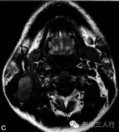 【病例】鳃裂囊肿并感染1例MR影像表现分析 【病例】鳃裂囊肿并感染1例MR影像表现分析