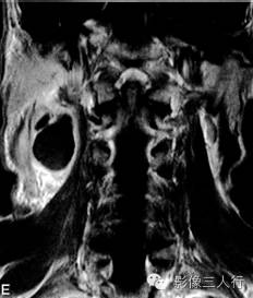 【病例】鳃裂囊肿并感染1例MR影像表现分析 【病例】鳃裂囊肿并感染1例MR影像表现分析