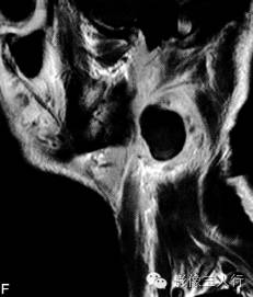 【病例】鳃裂囊肿并感染1例MR影像表现分析 【病例】鳃裂囊肿并感染1例MR影像表现分析