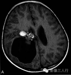 【病例】右侧幕上血管母细胞瘤1例MR表现分析 【病例】右侧幕上血管母细胞瘤1例MR表现分析