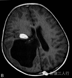 【病例】右侧幕上血管母细胞瘤1例MR表现分析 【病例】右侧幕上血管母细胞瘤1例MR表现分析