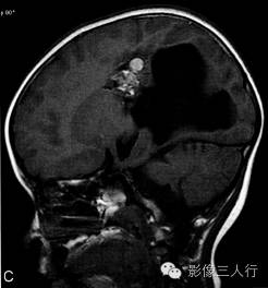 【病例】右侧幕上血管母细胞瘤1例MR表现分析 【病例】右侧幕上血管母细胞瘤1例MR表现分析