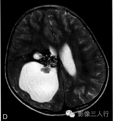 【病例】右侧幕上血管母细胞瘤1例MR表现分析 【病例】右侧幕上血管母细胞瘤1例MR表现分析