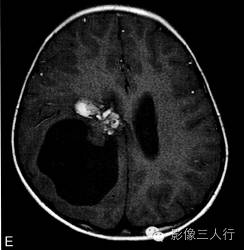 【病例】右侧幕上血管母细胞瘤1例MR表现分析 【病例】右侧幕上血管母细胞瘤1例MR表现分析