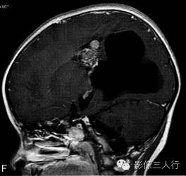 【病例】右侧幕上血管母细胞瘤1例MR表现分析 【病例】右侧幕上血管母细胞瘤1例MR表现分析