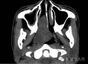【病例】鼻咽纤维血管瘤1例CT及MR影像表现分析
