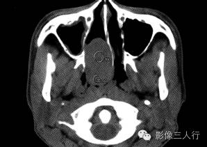 【病例】鼻咽纤维血管瘤1例CT及MR影像表现分析 【病例】鼻咽纤维血管瘤1例CT及MR影像表现分析