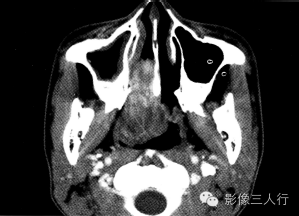 【病例】鼻咽纤维血管瘤1例CT及MR影像表现分析 【病例】鼻咽纤维血管瘤1例CT及MR影像表现分析