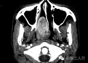 【病例】鼻咽纤维血管瘤1例CT及MR影像表现分析 【病例】鼻咽纤维血管瘤1例CT及MR影像表现分析