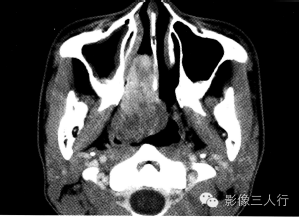 【病例】鼻咽纤维血管瘤1例CT及MR影像表现分析 【病例】鼻咽纤维血管瘤1例CT及MR影像表现分析
