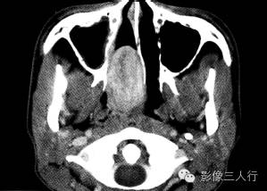 【病例】鼻咽纤维血管瘤1例CT及MR影像表现分析 【病例】鼻咽纤维血管瘤1例CT及MR影像表现分析